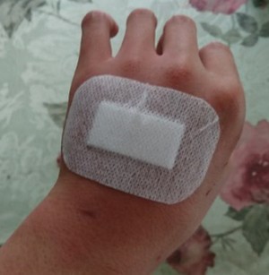 猫に噛まれた手を病院で処置 画像